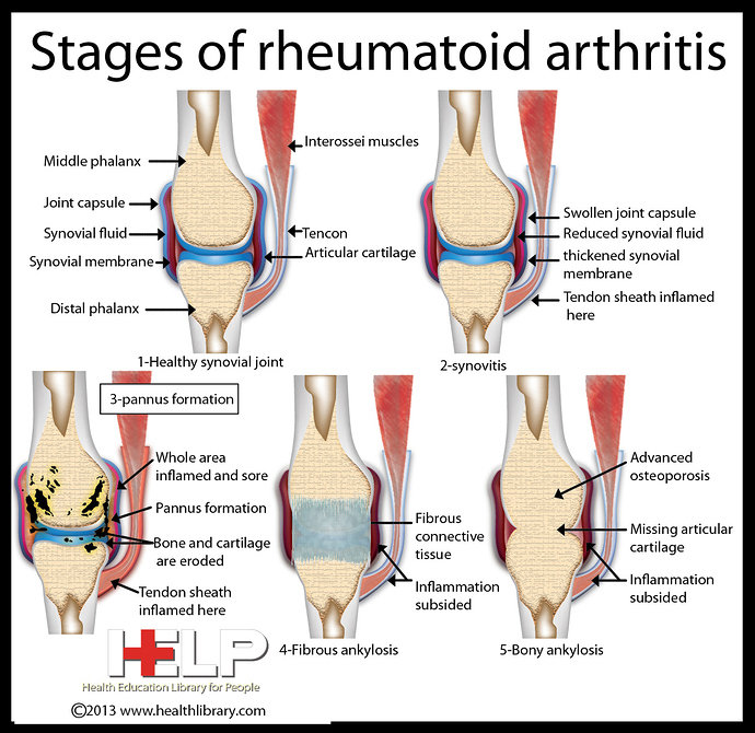 Radang Sendi atau Artritis Reumatoid