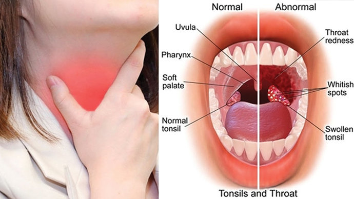 Penyakit Amandel atau Tonsilitis