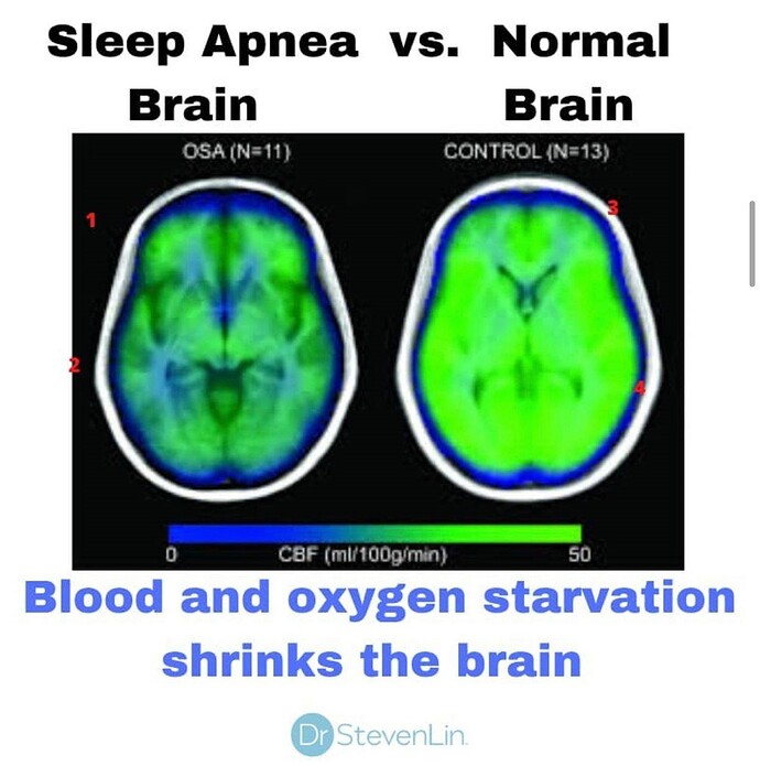 Brain Damage because of Sleep Apnea by Steevn Lin