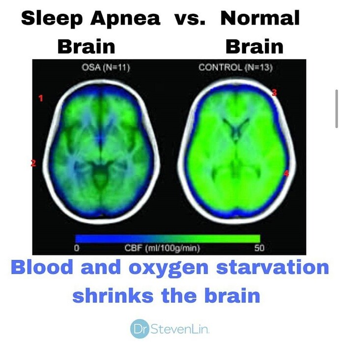 Brain Damage because of Sleep Apnea by Steevn Lin - Copy (2)