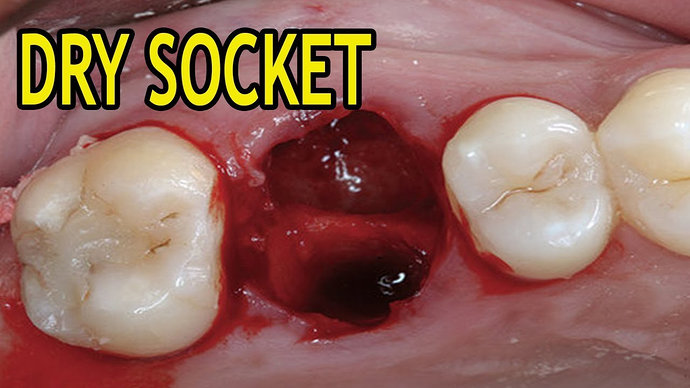 Dry Socket atau Alveolar Osteitis