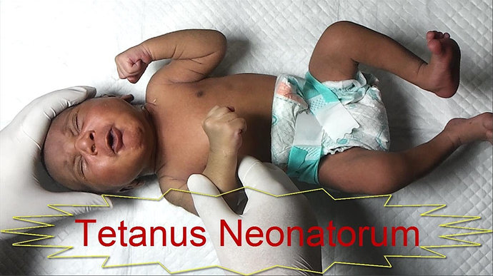 Tetanus neonatorum