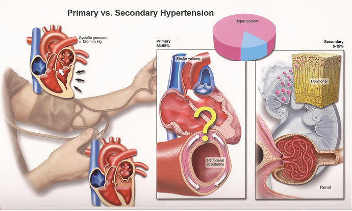 Hipertensi (Tekanan Darah Tinggi) esensial