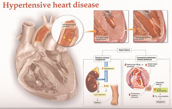 Penyakit jantung hipertensi