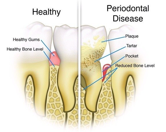 Gejala penyakit periodontium