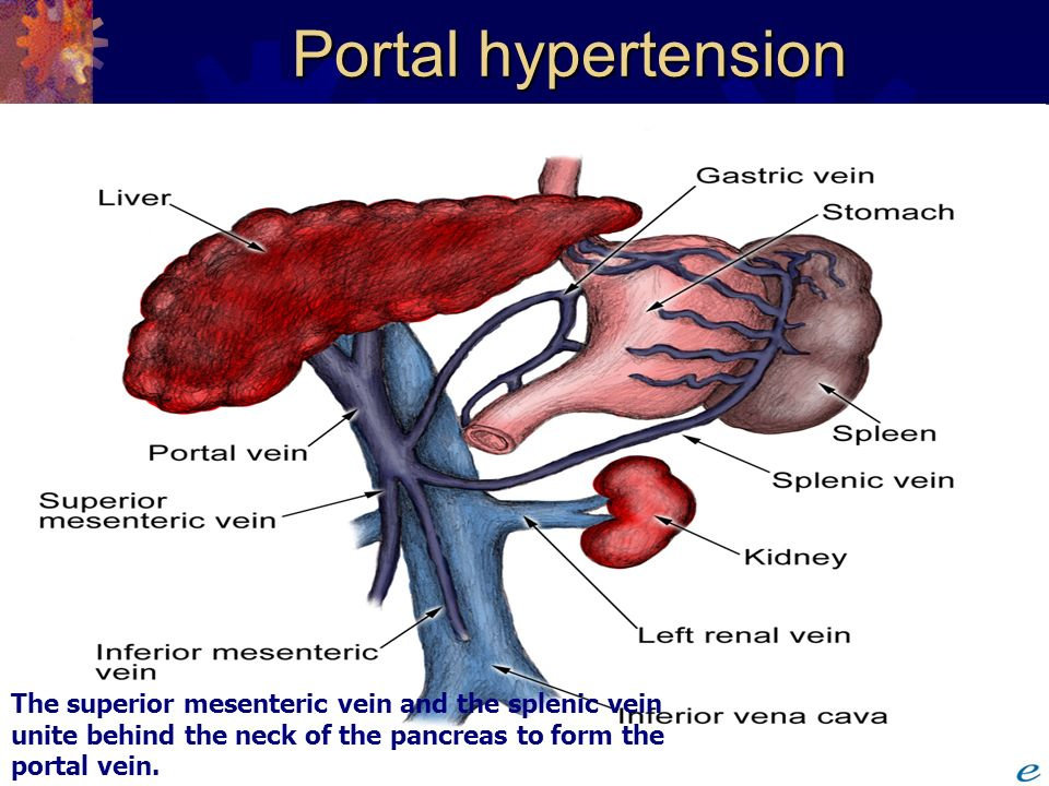 Apa yang dimaksud dengan Hipertensi  portal Ilmu 