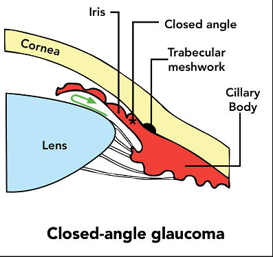 Glaukoma sudut tertutup