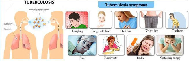 Gejala tuberkolosis paru