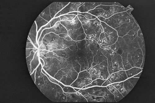 Angiografi retinopati diabetik