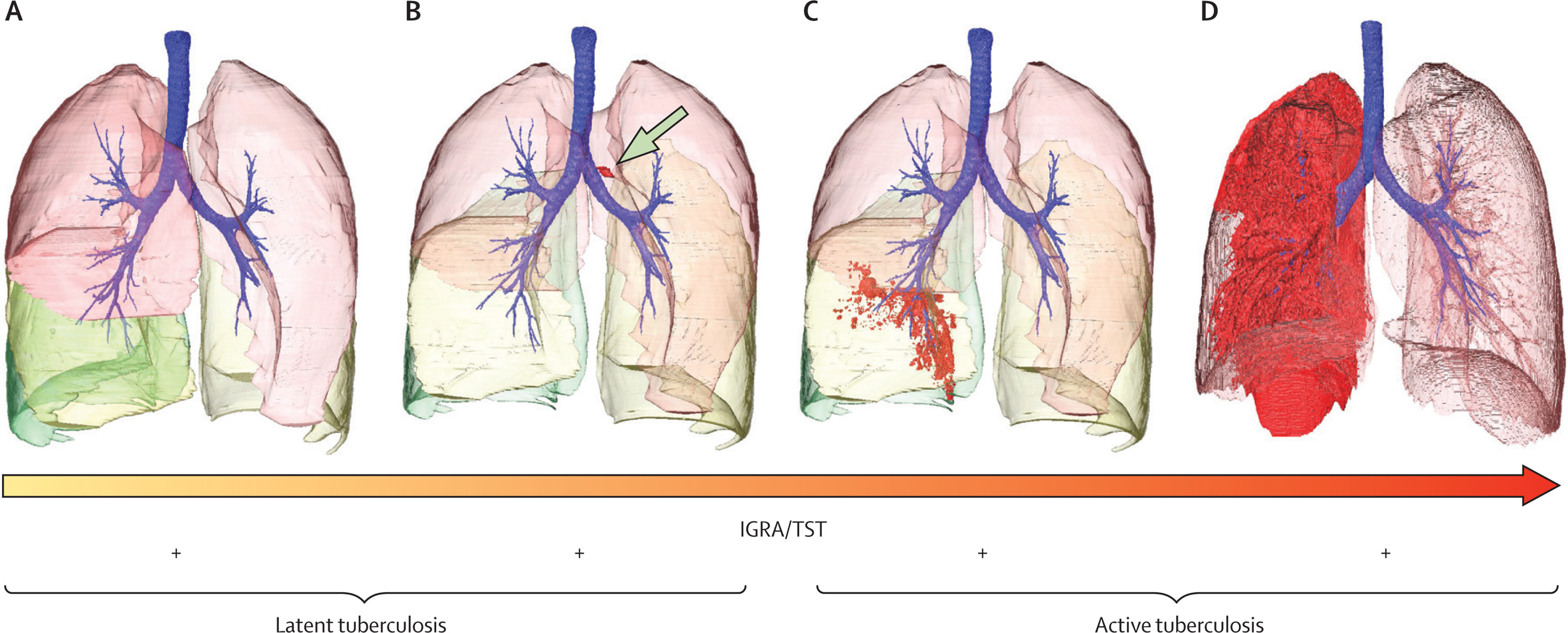Поражаемые органы туберкулеза. Лёгкие поражённые туберкулёзом. Стадии туберкулезного процесса легких.