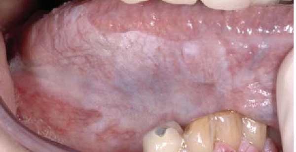 Homogenous leukoplakia padapinggir lidah