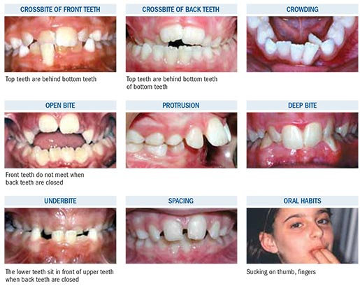Contoh Ortodontik interseptif pada anak