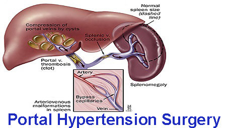 Hipertensi portal