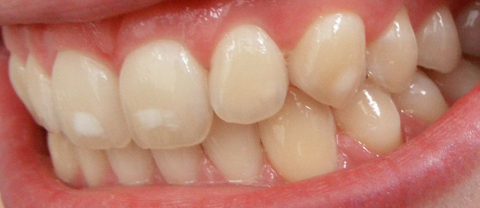 Bercak putih pada gigi atau Fluorosis gigi