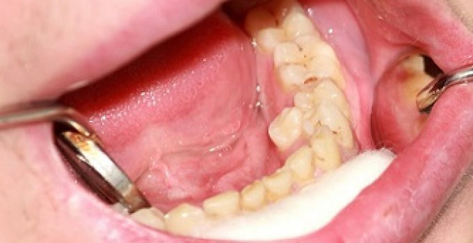 Gigi berlebih atau Hyperdontia