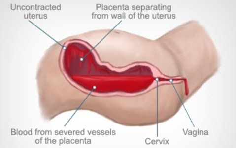 Atonia uteri
