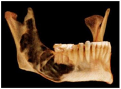 Terlihat permukaan lesi dengan I-Cat; gambaran ekspansi lesi ke arah anteroposterior, tampak terjadi resorpsi pada gigi
