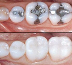 dental_restoration-300x270