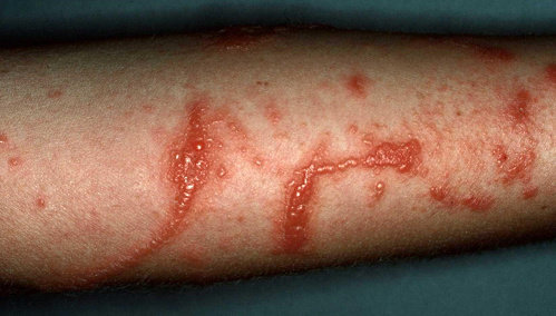 Dermatitis kontak alergik