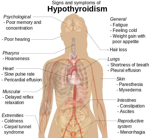 Gejala Hipotiroidisme