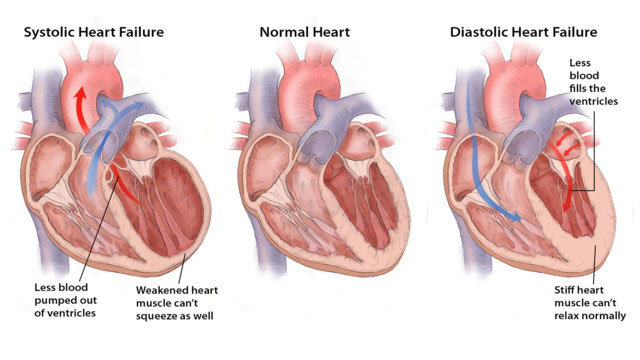 Gagal jantung (akut dan kronik)