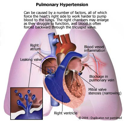 a pulmonalis hipertónia okai magas vérnyomás nyomás 120-100