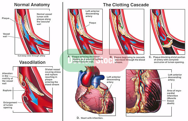 Serangan Jantung atau Infark miokard