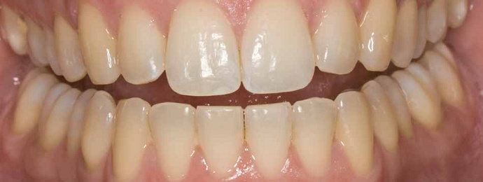 Minimal intervensi perawatan gigi