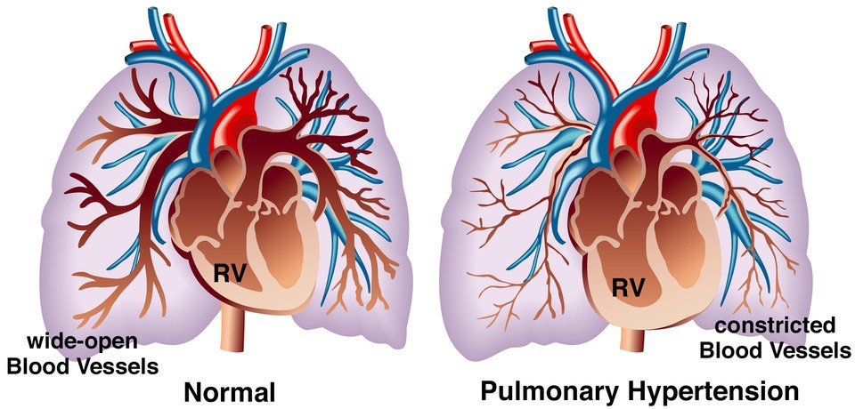 a pulmonalis hipertónia okai magas vérnyomás késleltetés