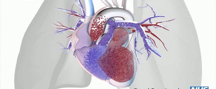 Hipertensi pulmonal
