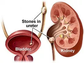 Batu yang ada di saluran ureter