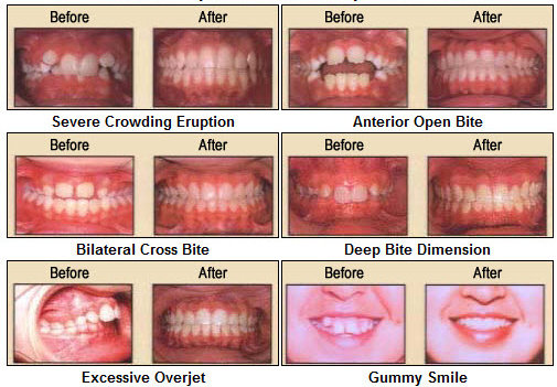 Kondisi Gigi Sebelum dan sesudah Perawatan Ortodontik interseptif