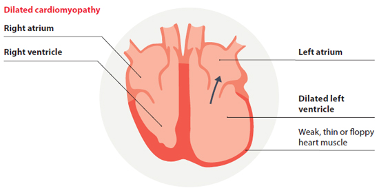Apa yang Anda ketahui tentang Dilated cardiomyopathy (DCM) ?