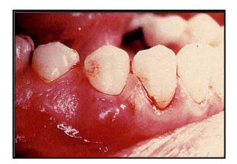 Abses periodontal akut