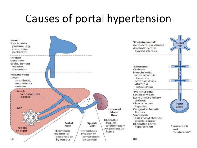 hipertensi portal