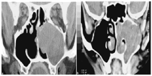 (a) Kasus 1. CT scan memperlihatkan ameloblastoma pada sinus maxillaris dan cavum nasi. Radiografi dan eksplorasi bedah menunjukkan dasar sinus yang intak. (b) Kasus 2. CT scan potongan coronal dari ameloblastoma yang luas yang memenuhi sinus maxillaris sinistra dan cavum nasi dengan erosi tulang dinding sinus lateral dan dasar orbita