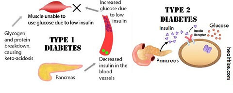 Diabetes Mellitus Tipe 1 dan 2