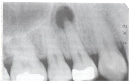 Gambaran radiografi periapikal granuloma