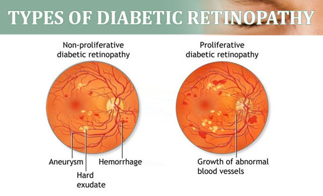 Retinopati diabetik