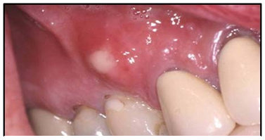 Abses periodontal