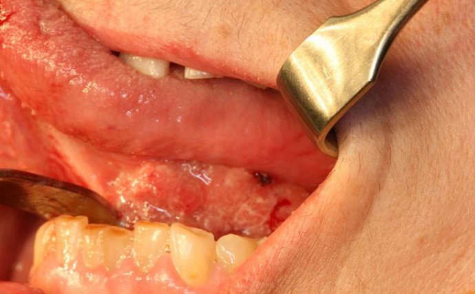 Karsinoma sel skuamosa rongga mulut