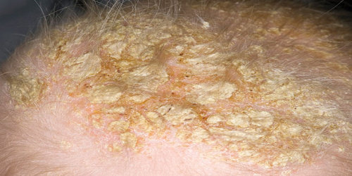Dermatitis seboroik pada kulit kepala