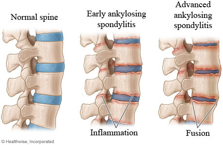 Hasil gambar untuk ankylosing spondylitis adalah