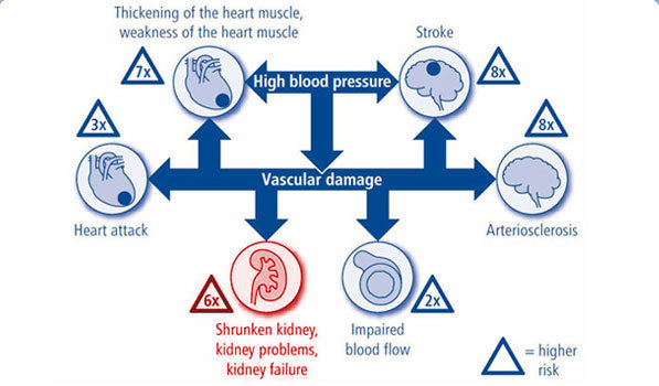 Kemungkinan atau Faktor Resiko Kerusakan Ginjal akibat Tekanan Darah Tinggi
