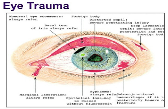 trauma okuli