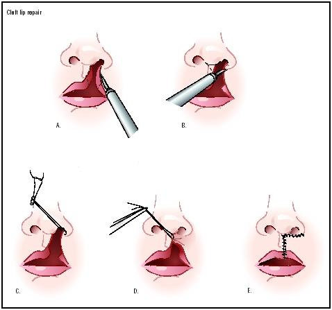 operasi bibir sumbing