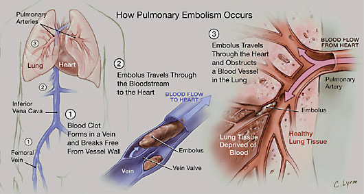 Hasil gambar untuk emboli paru