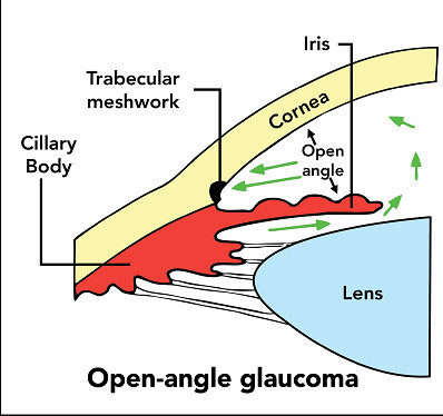 glaukoma sudut terbuka