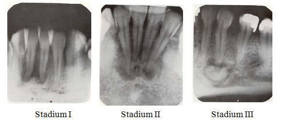 Gambaran Radiografis Cementoma