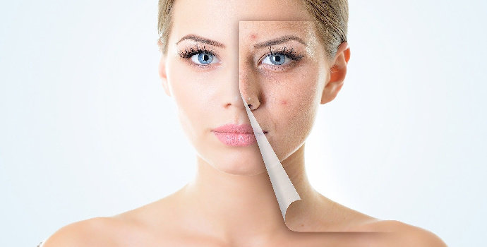 ara menghilangkan bruntusan di wajah yang paling efektif dengan menggunakan bahan-bahan alami